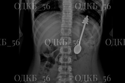 В Оренбурге хирурги достали из желудка ребенка 14-ти сантиметровую ложку