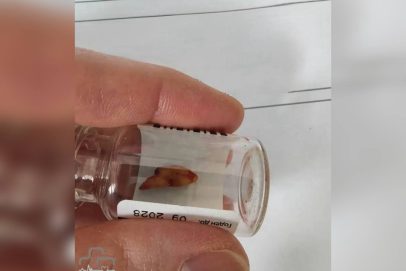 Дышите глубже: в Орске врачи достали зуб из носа пациента