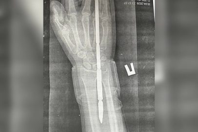 Гарпун насквозь: в Орске спасли неудачливого подводного охотника