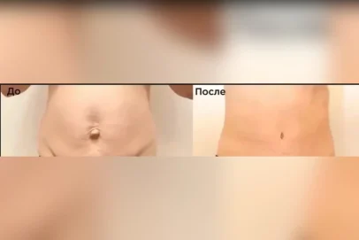 Медицинский прорыв в Новосергиевке: впервые проведена лапароскопия пупочной грыжи